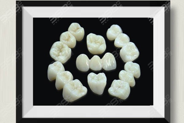 杭州国产/进口全瓷牙费用价格表 1300能做全瓷牙性价比超高