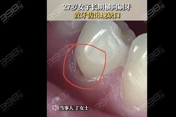 27岁女子长期横向刷牙致牙齿缺损