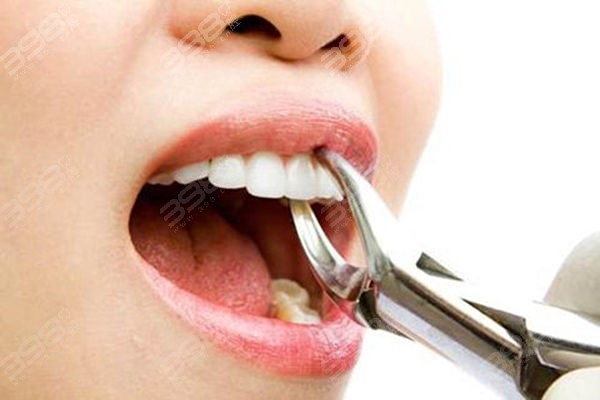 拔牙前一定要如实告知牙医病史 有这些问题的小伙伴不能随便拔牙！