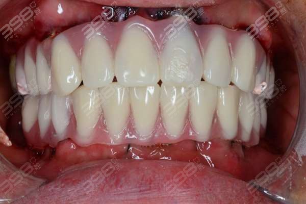 成都即拔即种牙整牙医院排名前十：华西、极光、新桥口腔种牙优势有目共睹
