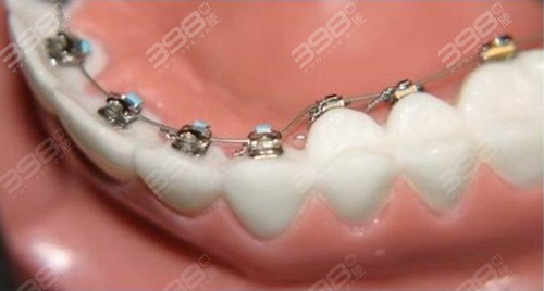 广州金属牙齿矫正口腔医院排名前十
