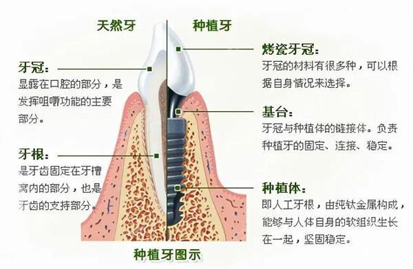 广州种植牙口腔医院排名