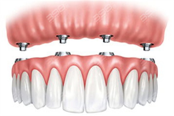 南宁All-on-4全/半口种植牙医院排名top10,皆是南宁种牙正规且受欢迎牙科