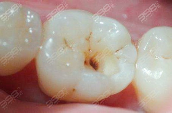 上海静安区牙防所补牙、根管治疗、洗牙、牙周治疗费用