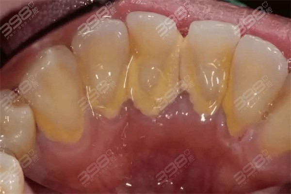 牙结石还会长进牙龈里面吗？牙龈里面的结石怎么清理疼不疼