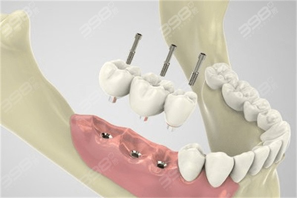 2024深圳新版牙科项目收费明细附带正规牙科推荐、集采价格