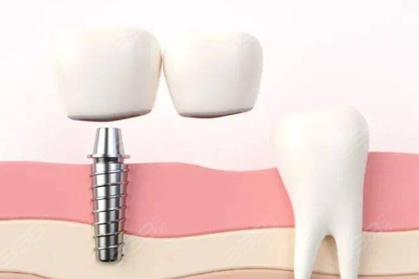 广安种植牙医院排名前五：爱牙仕、浩源、金典种牙技术高价格实惠