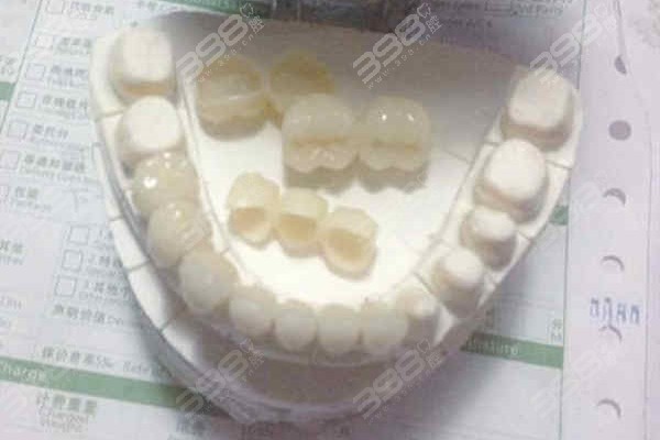 上海闵行区烤瓷牙、全瓷牙、活动假牙、吸附性义齿收费标准