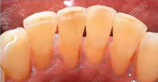中医讲牙齿有修复能力是真的还是假的