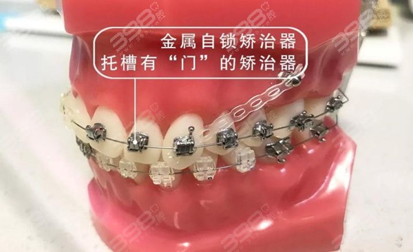 中山金属牙齿矫正口腔医院排名前十