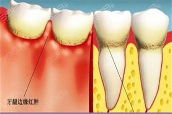 南宁牙周炎医院哪家好？分享南宁牙周治疗正规靠谱的牙科！