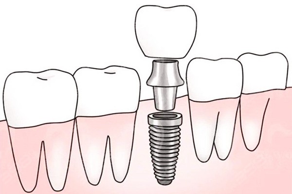 一文详解:种植牙有哪几种方式?对比常规种植牙和即刻负重哪种更好？