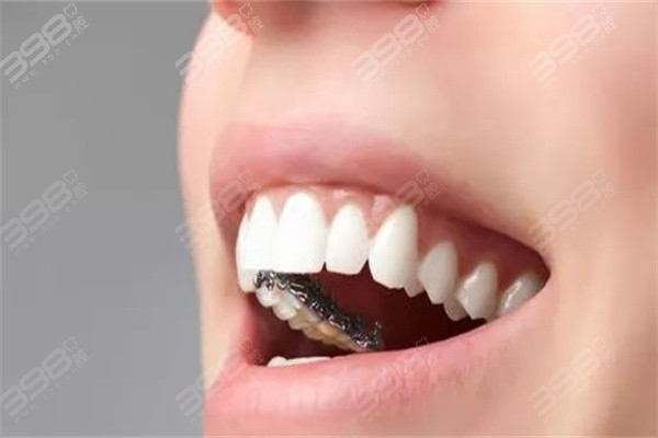 牙齿保持器哪种好？透明/哈雷/舌侧3种保持器优势大PK
