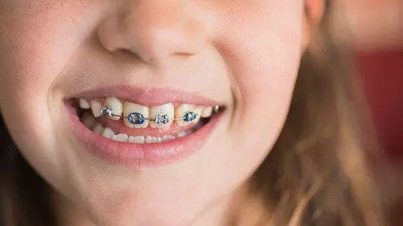 儿童几岁可以带牙套