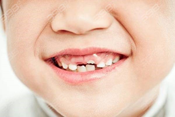 儿童几岁可以带牙套？牙齿矫正的这3个阶段一定要牢牢抓住