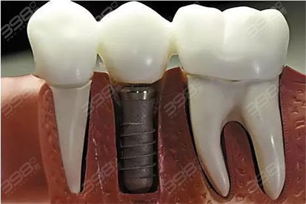 种植牙是怎么种上去的？关于种植手术一期、二期、三期流程大揭秘