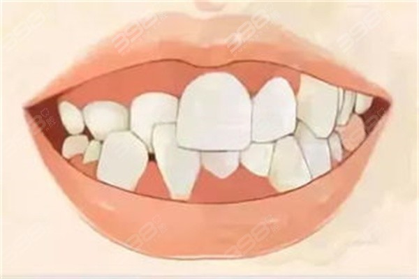 牙齿畸形