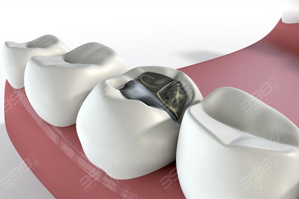 测评银汞补牙后有没有必要换树脂?当然,银汞合金会导致龋齿必须换