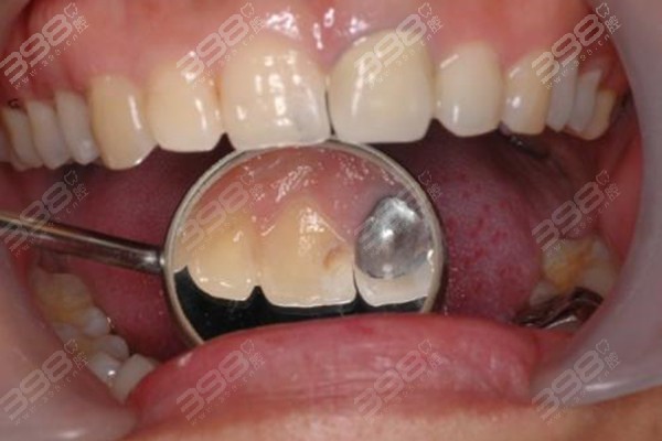 银汞补牙后有没有必要换树脂