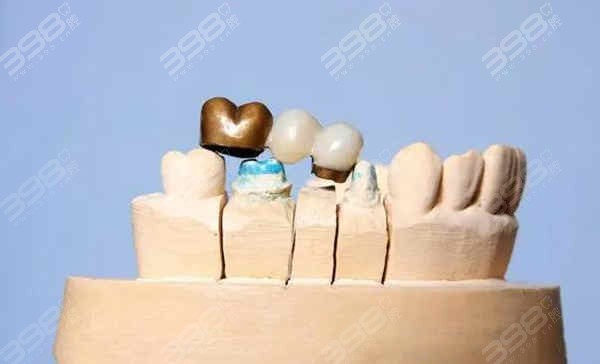 牙冠什么材质又好有耐用？