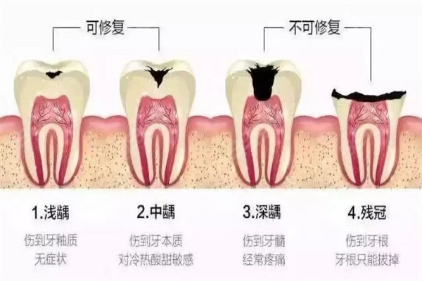 牙齿根管治疗费用一般多少钱一颗？前磨牙、后磨牙、双尖牙500元起
