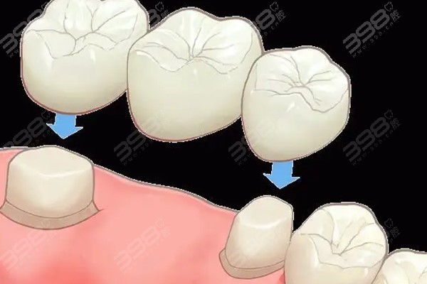汉中镶牙医院收费价格表：牙齿修复烤瓷牙、全瓷牙、种植牙收费价格