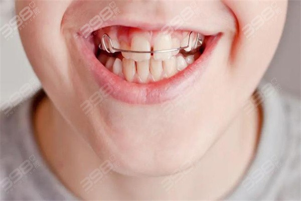 骨性龅牙可以矫正回来吗？