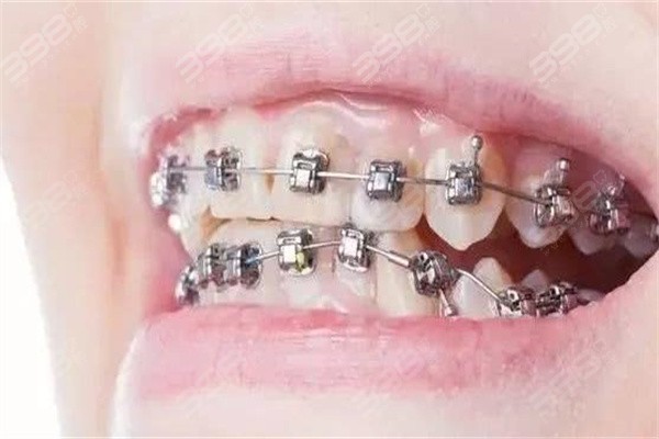骨性龅牙是什么？