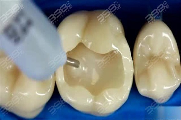 淮安市第二人民医院口腔科补牙、根管治疗价目表
