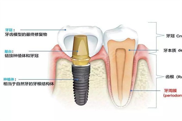 穿翼板种植牙手术是什么？