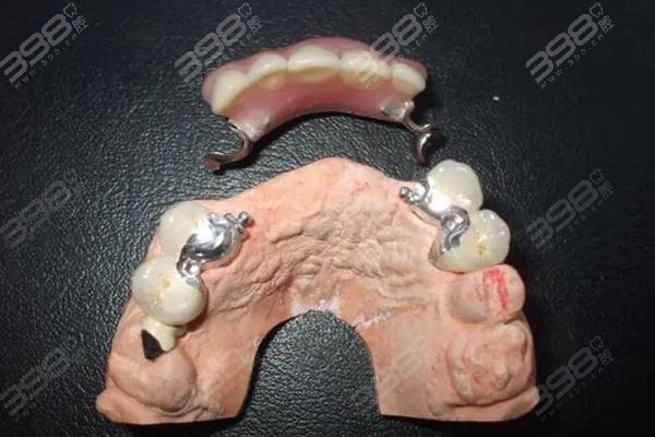 马里兰桥修复义齿图解：不需要磨两边牙优缺点明显
