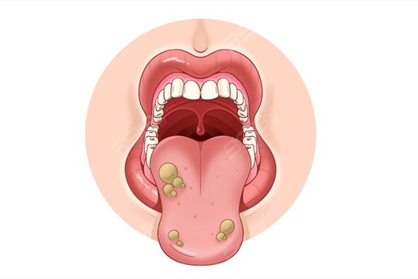 常见的口腔粘膜病有哪些