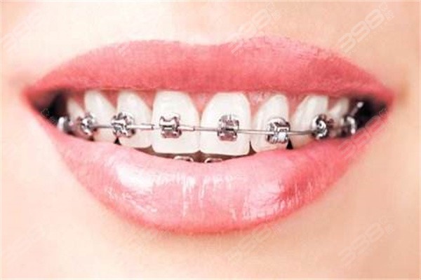 防城港牙齿矫正价格表2024,金属矫正6800+隐形矫正15000+附正畸便宜的牙科