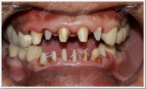 镶牙把牙齿磨小戴牙套的危害有哪些？
