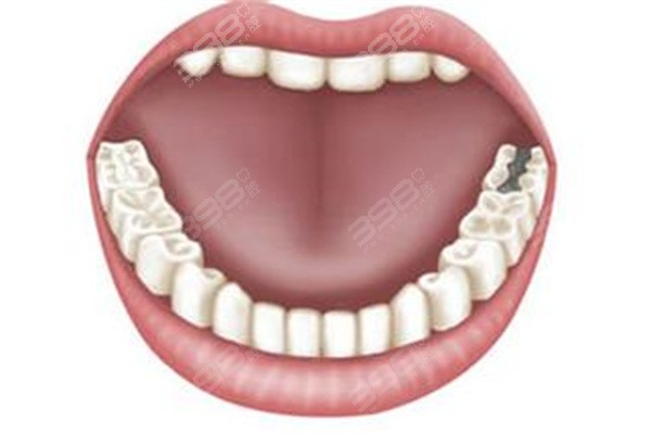单侧咀嚼会导致牙齿一边高一边低吗
