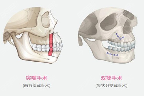 广州哪个医院做正颌手术好