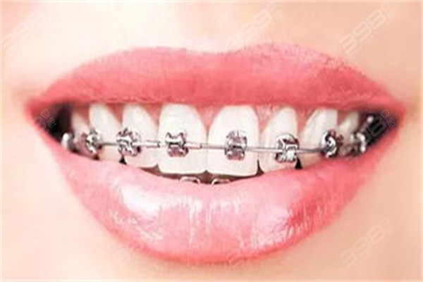 银川艾齿口腔医院牙齿矫正收费标准
