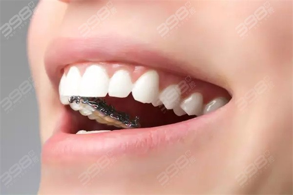 骨性龅牙戴牙套能矫正吗？速览骨性龅牙or牙性龅牙的矫正方式