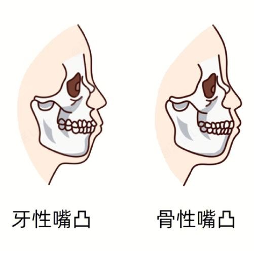 骨性龅牙