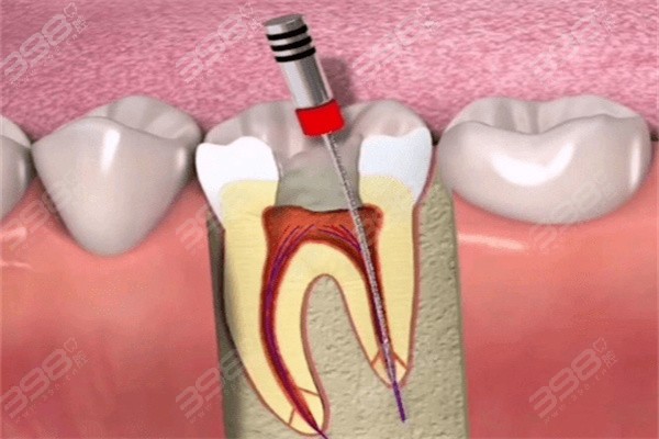常熟二院牙科根管治疗多少钱？