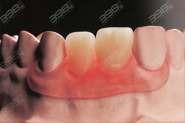 临时假牙和活动假牙的区别是什么