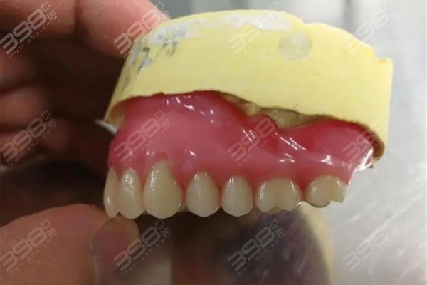 覆盖义齿和种植牙的区别