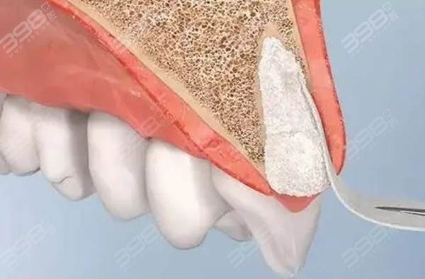 种植牙位点保存是什么意思？