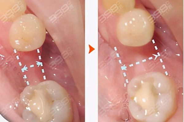 种植牙位点保存必须要做吗？
