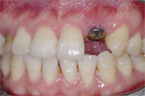 牙槽骨吸收严重还能种植吗？需要满足哪些条件才能进行种植手术？