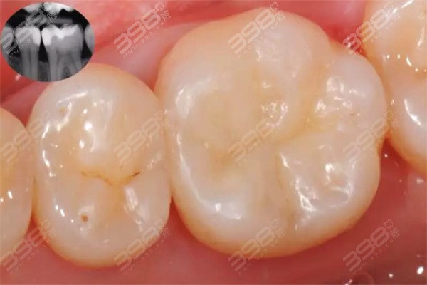 济南市口腔医院补牙收费标准：含弗莱堡、铂飞特、联合博士等口腔