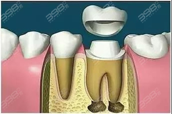 长沙根管治疗多少钱一颗牙齿？