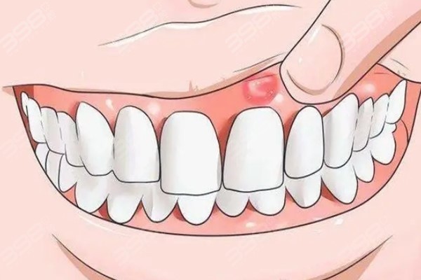 有牙龈炎可以拔牙吗？牙龈脓肿阶段可千万别拔牙