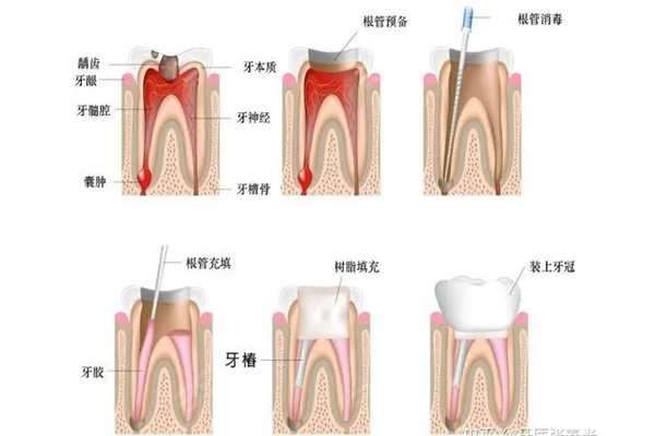 根管治疗牙齿