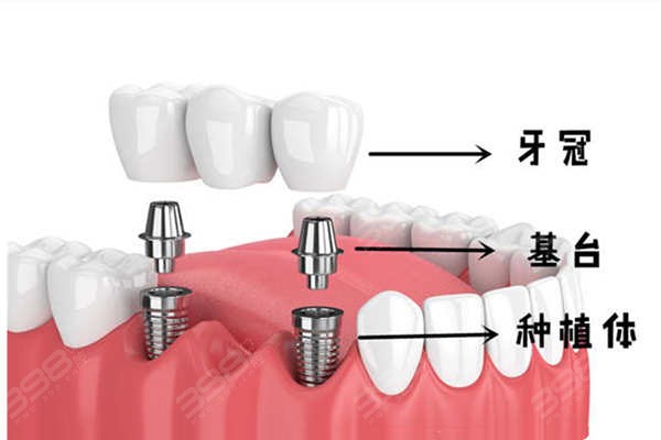 2024年广州种牙多少钱一颗？看种牙集采优惠价格及口腔医院排名